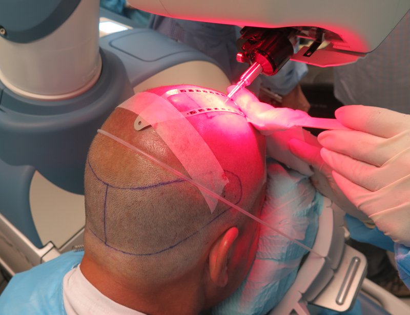 Robotic Hair Transplant In India & Europe