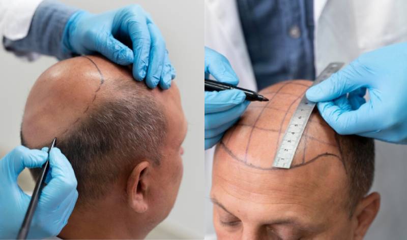BIO-FUE Transplant