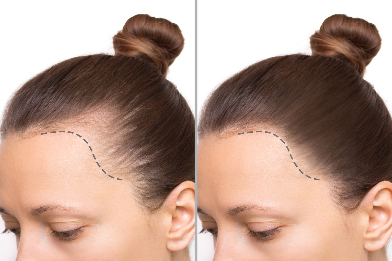 Female Hair Transplant